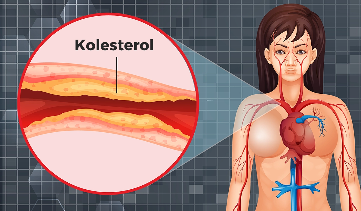 LDL, atau Low-Density Lipoprotein, adalah jenis lipoprotein yang tugasnya nganterin kolesterol ke seluruh tubuh.