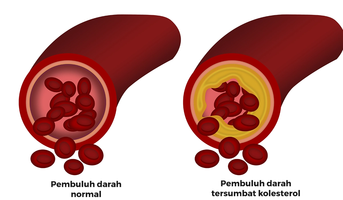 Apa itu LDL? Penyebab Kolesterol jahat (LDL) dan Cara Mengatasinya